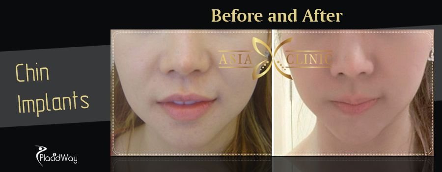 Before and After Chin Implants in Thailand